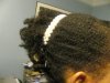 Traction alopecia 003.jpg